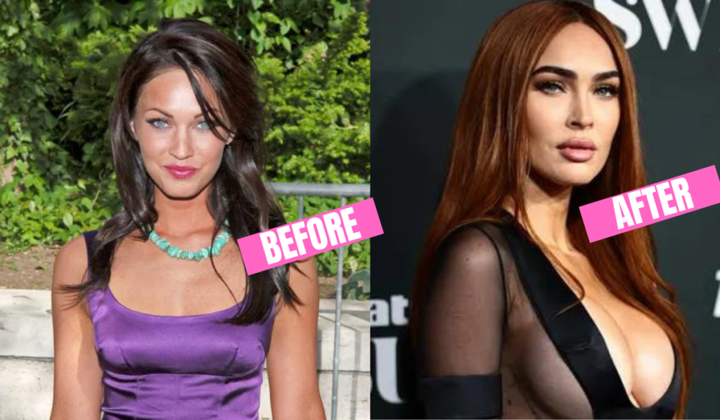 Megan Fox's Plastic Surgery